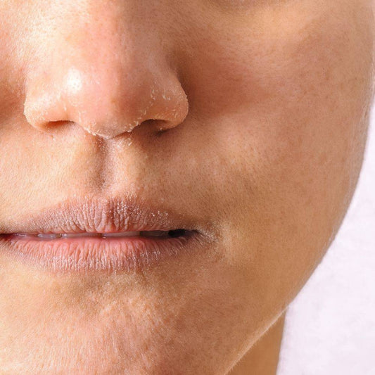 Dry Skin VS Dehydrated skin?